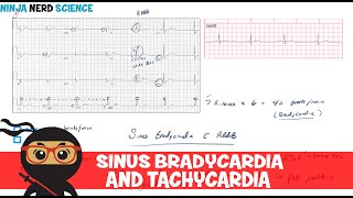 Rate and Rhythm  Sinus Bradycardia and Sinus Tachycardia [upl. by Sidwel]