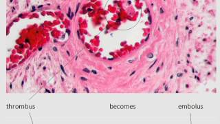 MedDef29 Thrombus vs Embolus [upl. by Zakarias]