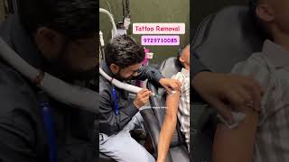 Permanent tatto removal best price Shamli up and panipat Haryana shorts tattoo removal [upl. by Dlorah137]