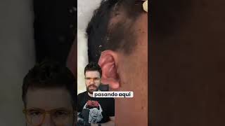 ⚠️🧠 Un traumatismo craneal que resulta en la salida de líquido cefalorraquídeo [upl. by Pearman376]