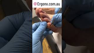 Little toe callus hard skin removal by podiatrist this makes the pinky toe more comfortable [upl. by Goodwin]