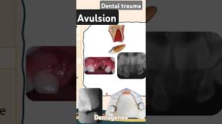 Dental trauma Avulsion [upl. by Lura507]