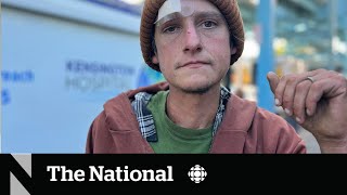 How a fleshrotting ‘zombie drug’ is complicating the overdose crisis [upl. by Aerdnaxela219]