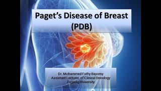 Pagets disease of breast [upl. by Inhoj]