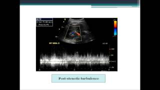 Renal Arteries From Start to Finish [upl. by Louisa]