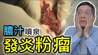 膿腫  Abscess  Epidermoid Cyst  Sebaceous Cyst Surgery  發炎粉瘤  排除膿液  皮膚專科  皮膚手術 [upl. by Dang]