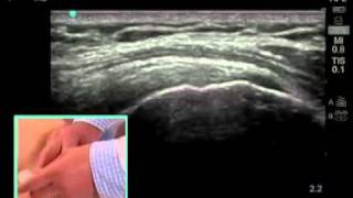 How To Ultrasound Guided Shoulder Injection Scanning Technique Video [upl. by Yeleak]