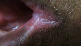 How To Cure Angular Cheilitis In 3 days [upl. by Tutt487]