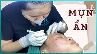 Big Cystic Acne Blackheads Extraction Blackheads amp Milia Whiteheads Removal Pimple Popping [upl. by Yffub]