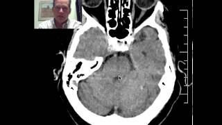 DISCUSSION of CT Head in 76yo patient with an acute MCA stroke [upl. by Boyer]