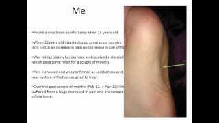 Ledderhose disease my experience and treatments [upl. by Berton]