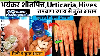 एक बार में ही 100 ठीक करे Urticaria शीतपित् इस रामबाण नुस्खे से Urticaria ka Ilaj पित्ती उछलना [upl. by Beverlee]