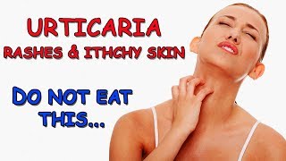 Itchy Skin amp Rashes  Urticaria  Avoid High Histamine Foods [upl. by Siravrat119]