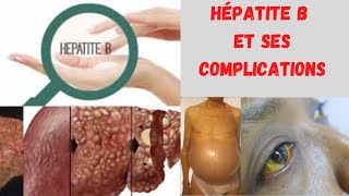 Lhépatite B Tout savoir sur le virus de lhépatite B ses complications et comment léviter [upl. by Eissolf37]