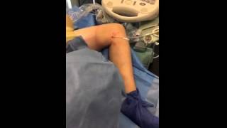 EVLT for Varicose Veins [upl. by Akemal982]