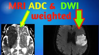 MRI Diffusionweighted image Brain DWI or ADC images MRI brain haryana MRI hindi classes [upl. by Burnham]