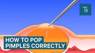 The Only Right Way To Pop Your Pimples [upl. by Ainitsirc]