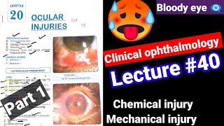 🔴Clinical ophthalmology lectures 40 ocular injuriesmechanicalchemical injury Contusion Hypema [upl. by Glanti13]