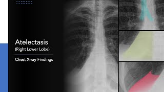 Atelectasis Right Lower Lobe Explanation of Chest Xray Findings [upl. by Fabri]