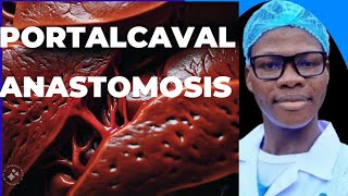 Portalcaval anastomosis Indication liver physiology and complications of the procedure [upl. by Adnek121]