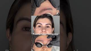 Láser correctivo para borrar cejas proceso [upl. by Shank406]