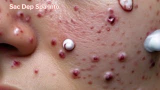 sac dep spa big deep blackheads  sac dep spa pimple popping Today new 2024 5 [upl. by Nat263]