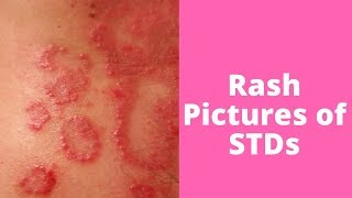 What’s This Rash Pictures of STDs [upl. by Buffum]