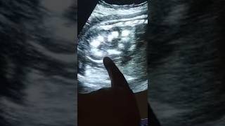 Intrauterine fetal nephrocalcinosis with severally oligohydromnios [upl. by Job282]