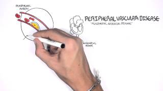 Cardiovascular Disease Overview [upl. by Hilary]