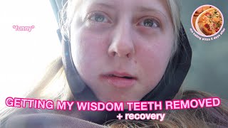 getting my wisdom teeth removed  fast recovery funny [upl. by Pillyhp948]