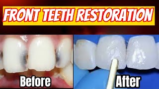 How to Fill Front Teeth Cavities with Dental Filling Procedure cavity removal dentalfilling vidiq [upl. by Hatnamas]