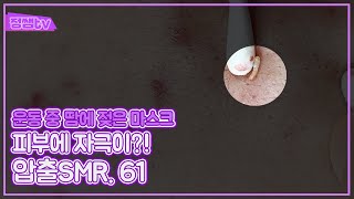 압출smr 61 운동하다 악화된 여드름 피부  20대 男 [upl. by Oberg]