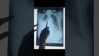 Chest XrayIatrogenic Hydropneumothorax [upl. by Rihat]