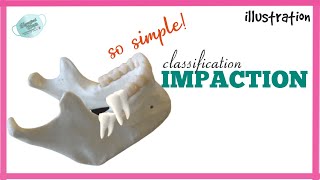 CLASSIFICATION OF IMPACTED TOOTH  IMPACTION [upl. by Deeanne599]