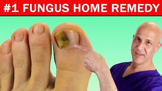 1 Best Home Remedy Cure for Toenail Fungus Dr Mandell [upl. by Aidnyl267]