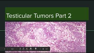 Yolk sac tumor and other tumors [upl. by Sedberry]