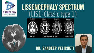 Lissencephaly SpectrumClassic Type1Sandeep VelichetIunderstanding lissencephaly microscopic level [upl. by Cumine]