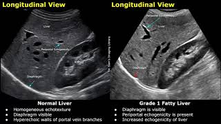 Fatty Liver Grading On Ultrasound  USG Normal Vs Abnormal Images  Grades 12 amp 3 Hepatic Steatosis [upl. by Ennaisoj]