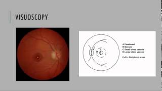 Visuoscopy Fixation Ophthalmoscopy [upl. by Ssyla]