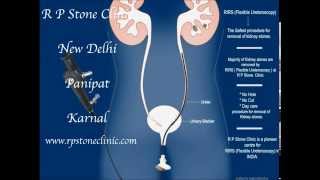 Animation of Kidney stone treatment by RIRS Flexible Ureteroscopy [upl. by Nuhsed]