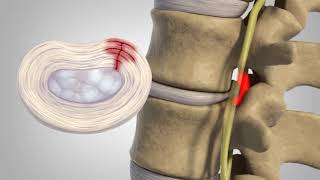 Herniated Disc  Patient Education [upl. by Hollerman]