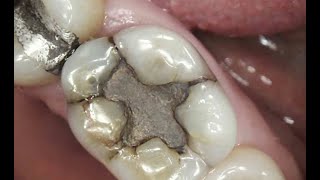 Amulgum filling procedure  Amulgum filling chandee ke filling in teeth 🦷 like subscribe plz [upl. by Audly]