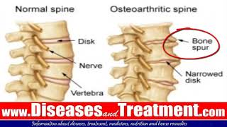 3 Osteophytes Bone Spur Causes Symptoms Diagnosis Treatment [upl. by Aicsila785]