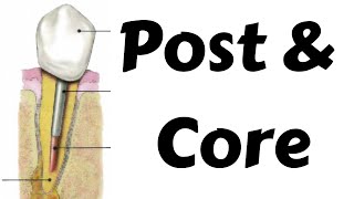 Post amp Core post preparation procedure in endodontic amp prosthodontics Step by step Dentsply calibra [upl. by Eimat313]