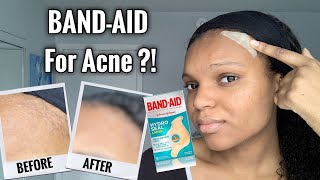 BANDAID FOR ACNE  I Tested Hydrocolloid Bandages for 1 Week  Hydro Seal BandAid for Acne [upl. by Buckels]