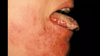 Shingles  Causes and Recovery [upl. by Akili]