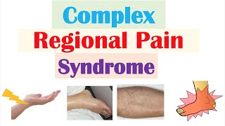 Complex Regional Pain Syndrome  Causes Pathophysiology Signs amp Symptoms Diagnosis Treatment [upl. by Llehcar]