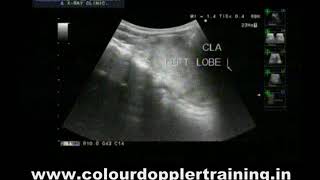 Doppler thyroid Retrosternal extension of thyroid [upl. by Nniuqal610]