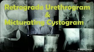 RGU MCU Retrograde Urethrogram and Micturating Cystogram Case Interpretation [upl. by Lertram]