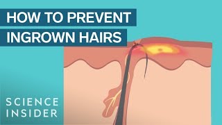 What Are Ingrown Hairs — And How To Treat Them [upl. by Ellehsem137]